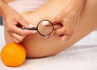 Cellulite cosa mangiare per dirle addio - RicettaSprint