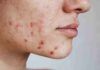 Acne da cibo cambia subito dieta - RicettaSprint