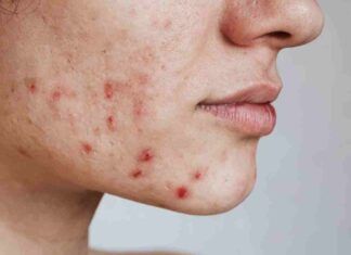 Acne da cibo cambia subito dieta - RicettaSprint